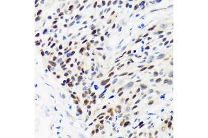 Immunohistochemistry of paraffin-embedded Human esophageal cancer using WDHD1 Rabbit pAb (ABIN7271351) at dilution of 1:100 (40x lens). (WDHD1 antibody  (AA 830-1129))