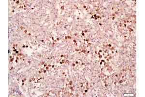 Formalin-fixed and paraffin embedded human lung carcinoma labeled with Anti-Phospho-MAPKAPK2(Thr334) Polyclonal Antibody, Unconjugated (ABIN743693) at 1:200 followed by conjugation to the secondary antibody and DAB staining (MAPKAP Kinase 2 antibody  (pThr334))