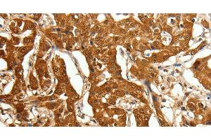 Immunohistochemistry of paraffin-embedded Human lung cancer using Otocadherin Polyclonal Antibody at dilution of 1:80 (CDH23 antibody)