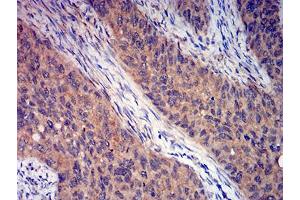 Immunohistochemical analysis of paraffin-embedded cervical cancer tissues using GRM3 mouse mAb with DAB staining. (Metabotropic Glutamate Receptor 3 antibody  (AA 433-576))