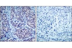 Immunohistochemistry analysis of paraffin-embedded human breast carcinoma tissue, using HDAC2 (Ab-394) Antibody. (HDAC2 antibody  (AA 360-409))