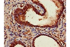Immunohistochemistry of paraffin-embedded human prostate cancer using ABIN7150624 at dilution of 1:100 (Mre11 antibody  (AA 1-205))