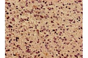 Immunocytochemistry analysis of human glioma using ABIN7171638 at dilution of 1:100 (TBC1D31 antibody  (AA 662-1001))