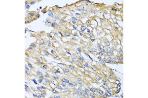 Immunohistochemistry of paraffin-embedded human prostate cancer using CCL8 antibody at dilution of 1:100 (40x lens). (CCL8 antibody)