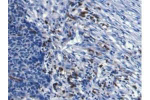 Detection of S100A8 in Human Ovarian cancer Tissue using Monoclonal Antibody to S100 Calcium Binding Protein A8 (S100A8) (S100A8 antibody  (AA 1-93))