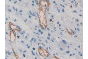 DAB staining on IHC-P; Samples: Human Glioma Tissue) (VEGFA antibody  (AA 28-147))
