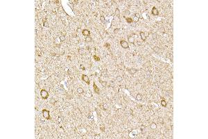 Immunohistochemistry of paraffin-embedded human liver cancer using SREBP2 Rabbit pAb (ABIN6128781, ABIN6148430, ABIN6148432 and ABIN6216892) at dilution of 1:50 (40x lens). (SREBF2 antibody  (AA 1-220))