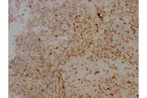 IHC image of ABIN7127357 diluted at 1:100 and staining in paraffin-embedded human cervical cancer performed on a Leica BondTM system. (Recombinant Aurora Kinase B antibody)