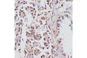 Immunohistochemistry of paraffin-embedded human lung cancer using RP/RP/RP antibody (ABIN6128653, ABIN6147083, ABIN6147084 and ABIN6214011) at dilution of 1:100 (40x lens). (RPA1 antibody  (AA 1-240))