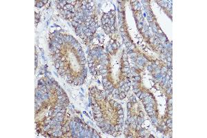 Immunohistochemistry of paraffin-embedded human colon carcinoma using  Rabbit pAb (ABIN7265359) at dilution of 1:50 (40x lens). (ABI1 antibody  (AA 180-230))