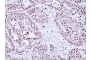 IHC-P Image Immunohistochemical analysis of paraffin-embedded NCIN87 Xenograft, using NR2C2, antibody at 1:100 dilution. (TR4 antibody)