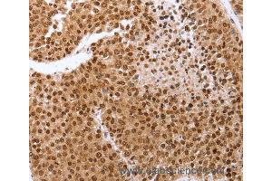 Immunohistochemistry of Human lung cancer using PTTG1 Polyclonal Antibody at dilution of 1:60 (PTTG1 antibody)