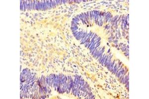 Immunohistochemistry of paraffin-embedded human ovarian cancer using ABIN7155449 at dilution of 1:100 (CARM1 antibody  (AA 209-379))