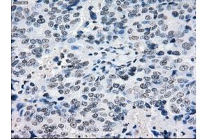 Immunohistochemical staining of paraffin-embedded Adenocarcinoma of colon tissue using anti-CRYABmouse monoclonal antibody. (CRYAB antibody)