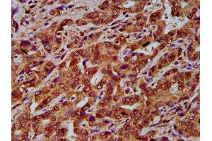 IHC image of ABIN7148830 diluted at 1:200 and staining in paraffin-embedded human liver cancer performed on a Leica BondTM system. (GARP antibody  (AA 131-253))