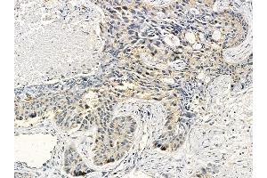 Cytokeratin 16 Mouse Monoclonal Antibody at 1/100 staining human lung cancer and adjacent non-tumor tissue by IHC-P.