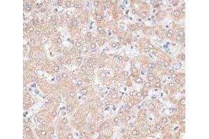 Immunohistochemistry of paraffin-embedded Human liver using GPC3 Polyclonal Antibody at dilution of 1:100 (40x lens). (Glypican 3 antibody)