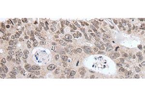 Immunohistochemistry of paraffin-embedded Human colorectal cancer tissue using HIST1H3A Polyclonal Antibody at dilution of 1:35(x200)