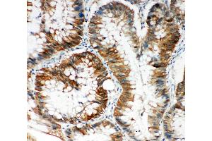 Anti-SQSTM1/p62 antibody, IHC(P) IHC(P): Human Intestinal Cancer Tissue (SQSTM1 antibody  (N-Term))