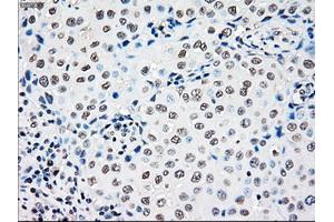 Immunohistochemical staining of paraffin-embedded Adenocarcinoma of colon tissue using anti-RAD9Amouse monoclonal antibody. (RAD9A antibody)