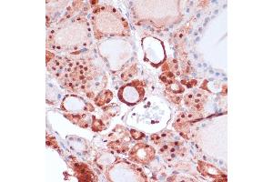 Immunohistochemistry of paraffin-embedded human thyroid cancer using S100 antibody (ABIN7270126) at dilution of 1:100 (40x lens). (S100A5 antibody  (AA 1-92))