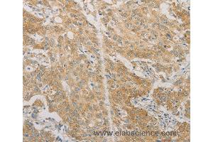 Immunohistochemistry of Human gastric cancer using ACSL4 Polyclonal Antibody at dilution of 1:60