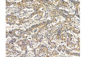 ABIN7095945 and ABIN7100007 at 1/100 staining human colorectal cancer by IHC-P. (RASGRP4 antibody)
