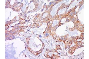 Paraformaldehyde-fixed, paraffin embedded human lung carcinoma, Antigen retrieval by boiling in sodium citrate buffer (pH6) for 15min, Block endogenous peroxidase by 3% hydrogen peroxide for 30 minutes, Blocking buffer (normal goat serum) at 37°C for 20min, Antibody incubation with Rabbit Anti-BAK Polyclonal Antibody, Unconjugated  at 1:500 overnight at 4°C, followed by a conjugated secondary and DAB staining. (BAK1 antibody  (AA 21-120))