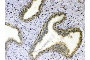 IHC testing of FFPE human breast cancer tissue with TNFSF18 antibody at 1ug/ml. (TNFSF18 antibody)