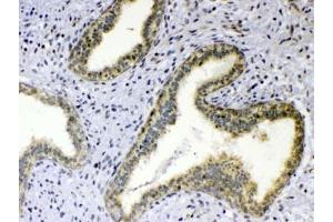 IHC testing of FFPE human breast cancer tissue with TNFSF18 antibody at 1ug/ml.
