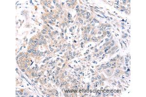 Immunohistochemistry of Human prostate cancer using ROR1 Polyclonal Antibody at dilution of 1:45