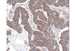 IHC-P Image Immunohistochemical analysis of paraffin-embedded human gastric cancer, using survivin , antibody at 1:100 dilution. (Survivin antibody  (C-Term))