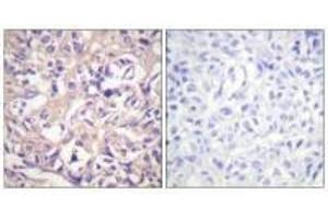 Immunohistochemistry analysis of paraffin-embedded human breast carcinoma tissue using TK (Ab-13) antibody. (TK1 antibody  (Ser13))