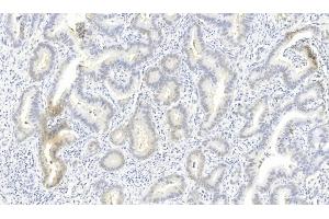 Immunohistochemical analysis of paraffin-embedded Human Lung adenocarcinoma section using Pink1 (ABIN6243980 and ABIN6577274). (ROS1 antibody)