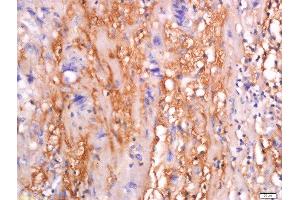 Formalin-fixed and paraffin embedded human colon carcinoma tissue labeled with Anti-sFRP-4 Polyclonal Antibody, Unconjugated  at 1:200 followed by conjugation to the secondary antibody and DAB staining. (SFRP4 antibody  (AA 151-260))