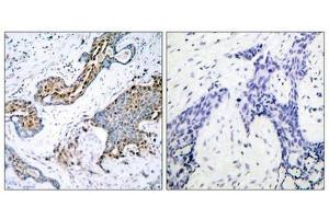 Immunohistochemical analysis of paraffin-embedded human breast carcinoma tissue using Estrogen Receptor-a(Phospho-Ser118) Antibody(left) or the same antibody preincubated with blocking peptide(right). (Estrogen Receptor alpha antibody  (pSer118))