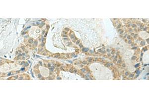 Immunohistochemistry of paraffin-embedded Human thyroid cancer tissue using KLC2 Polyclonal Antibody at dilution of 1:120(x200)