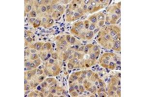 Immunohistochemical analysis of UQCR10 staining in human liver cancer formalin fixed paraffin embedded tissue section. (UQCR10 antibody)