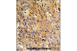 Formalin-fixed and paraffin-embedded human hepatocarcinoma with Cyclin A (CCNA2) Antibody (N-term), which was peroxidase-conjugated to the secondary antibody, followed by DAB staining.