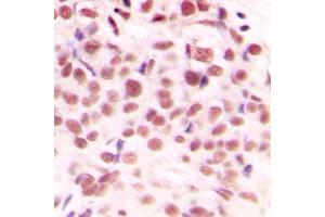 Immunohistochemical analysis of c-Myc (pS62) staining in human breast cancer formalin fixed paraffin embedded tissue section. (c-MYC antibody  (N-Term, pSer62))