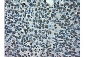 Immunohistochemical staining of paraffin-embedded Carcinoma of kidney tissue using anti-NEK6mouse monoclonal antibody.
