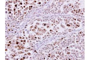 IHC-P Image karyopherin alpha 2 antibody [C3], C-term detects karyopherin alpha 2 protein at nucleus on human lung adenocarcinoma by immunohistochemical analysis. (KPNA2 antibody  (C-Term))