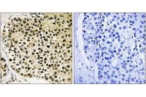 Immunohistochemistry analysis of paraffin-embedded human breast carcinoma, using NFAT3 (Phospho-Ser168+Ser170) Antibody.