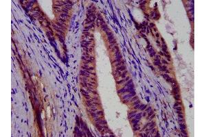 IHC image of ABIN7166555 diluted at 1:500 and staining in paraffin-embedded human colon cancer performed on a Leica BondTM system. (PCDH11X antibody  (AA 987-1117))