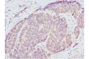 Immunohistochemistry of paraffin-embedded human gastric cancer using ABIN7151362 at dilution of 1:100 (ENOX2 antibody  (AA 411-610))