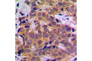 Immunohistochemical analysis of STAT5A staining in human breast cancer formalin fixed paraffin embedded tissue section. (STAT5A antibody  (C-Term))