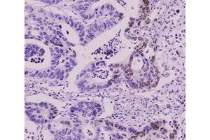 Paraffin embedded sections of colorectal canitrocelluloseer tissue were initrocelluloseubated with anti-human SUMO2/3 antibody (1:50) for 2 hours at room temperature. (SUMO2 antibody  (AA 1-93))
