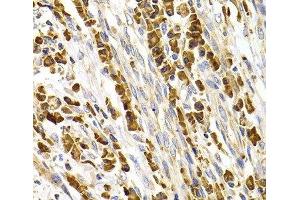 Immunohistochemistry of paraffin-embedded Human stomach cancer using TACR3 Polyclonal Antibody at dilution of 1:100 (40x lens).