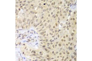 Immunohistochemistry of paraffin-embedded human oophoroma using LHX4 antibody at dilution of 1:100 (x400 lens).