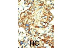 Formalin-fixed and paraffin-embedded human cancer tissue reacted with the primary antibody, which was peroxidase-conjugated to the secondary antibody, followed by DAB staining. (Dnmt2 antibody  (AA 346-375))